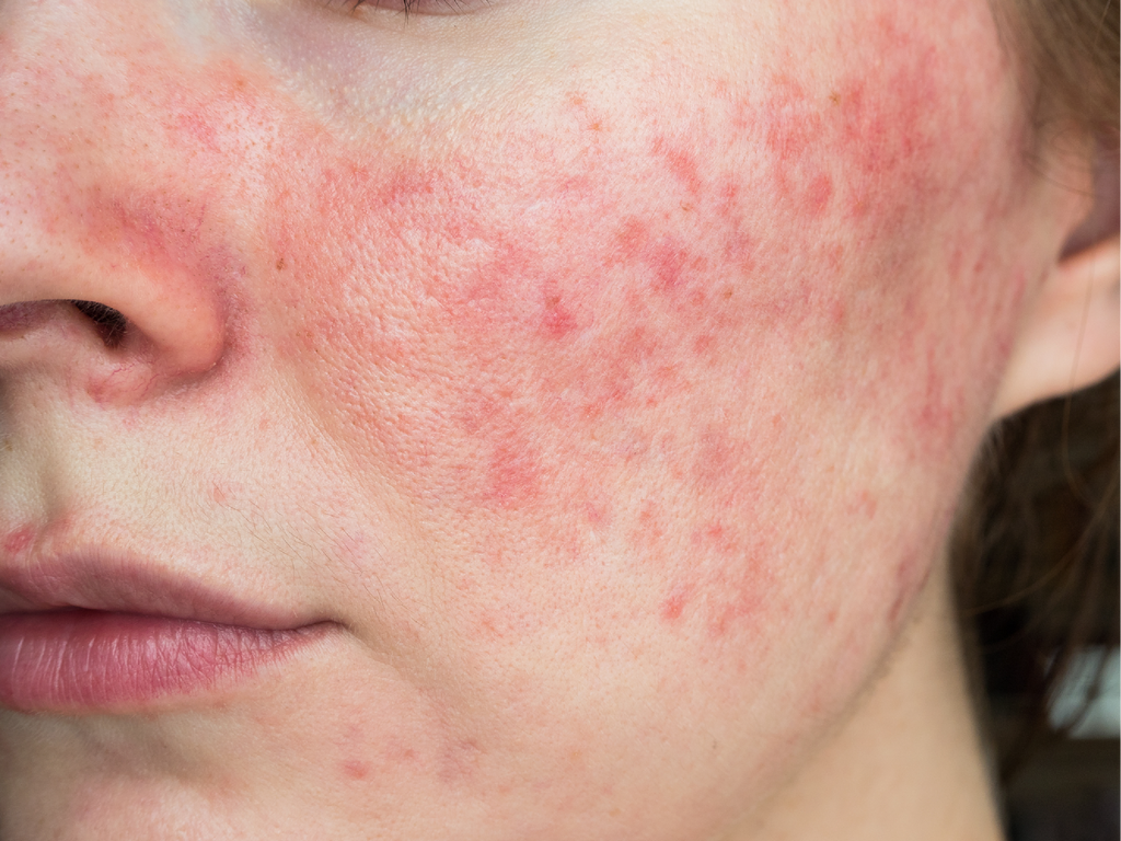 Mastering Rosacea Treatments – A Guide for Estheticians Using Dermastart Products