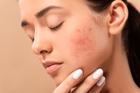 October 21: Treating Acne Scars with Dermastart Brands