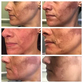Isomer Peel Professional System