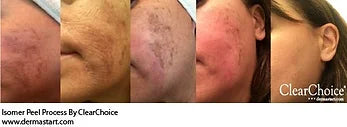 Isomer Peel Professional System