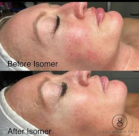 Isomer Peel Professional System